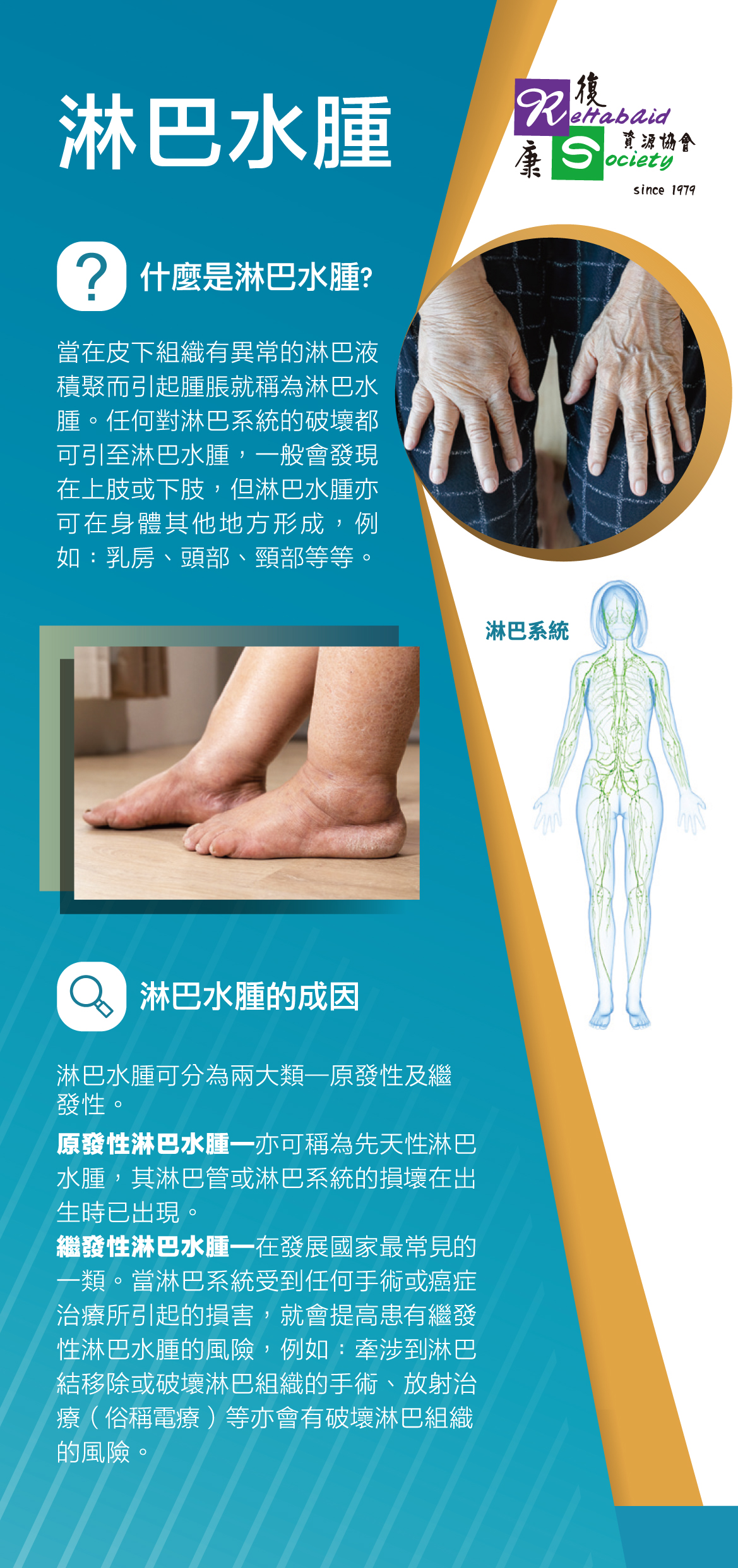 Lymphedema